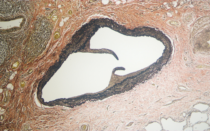 Verhoff’s Elastic Stain